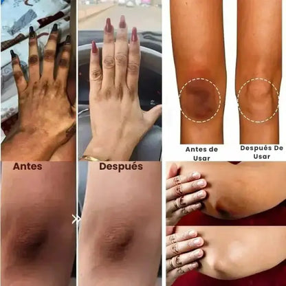 Kormesic® Serum Blanqueador de Nudillos