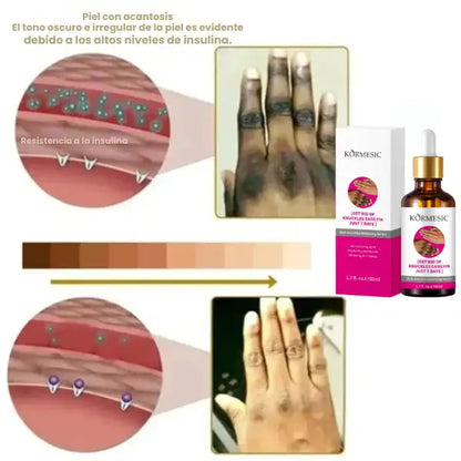 Kormesic® Serum Blanqueador de Nudillos